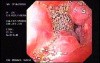 Duodenal B Cell Lymphoma (2 of 7)
