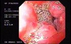 Duodenal B Cell Lymphoma (2 of 7)