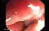 Severe case of Ischemic Colitis (7 of 19)