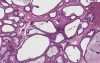 Juvenile polyp - Histopathology - Colon
