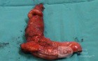 Barrett Adenocarcinoma - Endoscopic Image (16 of 20)