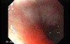 Adenocarcinoma of the Cardias - Proper Placement of the Stent