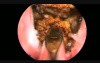 ThuLEP - Thulium Laser Enucleation of the Prostate
