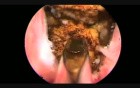 ThuLEP - Thulium Laser Enucleation of the Prostate