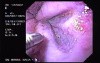 Hemorrhage due status post rubber band ligation of esophageal varices (9 of 25)