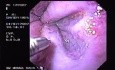 Hemorrhage due status post rubber band ligation of esophageal varices (9 of 25)