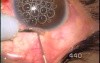 Juvenile Glaucoma. Singh Mictrotrack Filtration