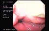 Banding of Esophageal Varices - Necrosis of Banded Varices