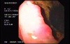Ulcerative Gastric Adenocarcinoma - Endoscopy
