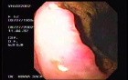 Ulcerative Gastric Adenocarcinoma - Endoscopy