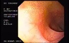 Ileum-transverse Anastomosis (3 of 3)