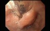 Menagement of the Endotracheal Tube