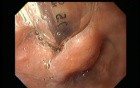 Menagement of the Endotracheal Tube