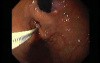 Gastric Varices - Endoscopic Ablation With Cyanoacrylate Glue (5 of 18)