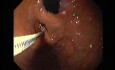 Gastric Varices - Endoscopic Ablation With Cyanoacrylate Glue (5 of 18)