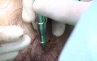 Hair Transplantation - Biofibre implantation