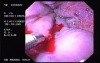 Hemorrhage due status post rubber band ligation of esophageal varices (10 of 25)