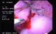 Hemorrhage due status post rubber band ligation of esophageal varices (10 of 25)