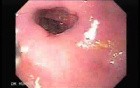 Esophageal Stricture After Total Gastrectomy And Chemoradiation - Application Of Mitomycin C - 1/2