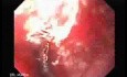 Severe Variceal Bleeding - Source of Bleeding
