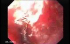 Severe Variceal Bleeding - Source of Bleeding