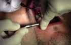 Implant Surgery #6 - Legacy-Implant Direct, Mineross Regenerated Bone