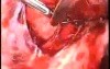 Laparoscopic Myomectomy Included In The Broad Ligament