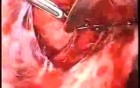 Laparoscopic Myomectomy Included In The Broad Ligament