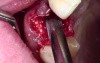 Tooth Extraction With Simple Socket Grafting