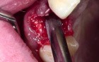 Tooth Extraction With Simple Socket Grafting