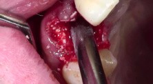Tooth Extraction With Simple Socket Grafting