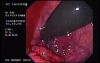 Rectal Cancer That Emerges In The Pectin Line (2 of 3)