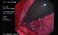 Rectal Cancer That Emerges In The Pectin Line (2 of 3)