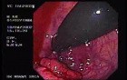 Rectal Cancer That Emerges In The Pectin Line (2 of 3)