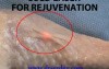 Skin rejuvenation - cold laser treatment