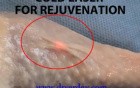 Skin rejuvenation - cold laser treatment