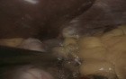 Nissen Fundoplication - Laparoscopic Approach