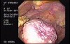 Oropharynge-Esophagic Candidiasis (4 of 5)