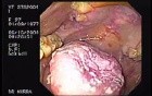 Oropharynge-Esophagic Candidiasis (4 of 5)