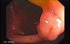 Sessile Tubulovillous Adenoma (1 of 11)