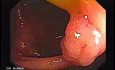 Sessile Tubulovillous Adenoma (1 of 11)