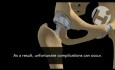 Complications From Total Hip Replacement