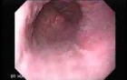 Barrett's Esophagus of long segment (4 of 11)