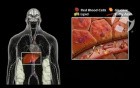 Hyperlipidemia