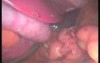 Sleeve Gastrectomy - SILS 
