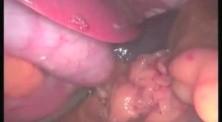 Sleeve Gastrectomy - SILS 