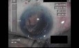 Cataract Surgery V - Part 4