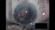 Cataract Surgery V - Part 4