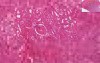 Diffuse Cortical Necrosis
