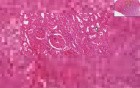 Diffuse Cortical Necrosis